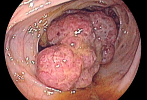 Рак на дебелото черво - снимка от колоноскопия